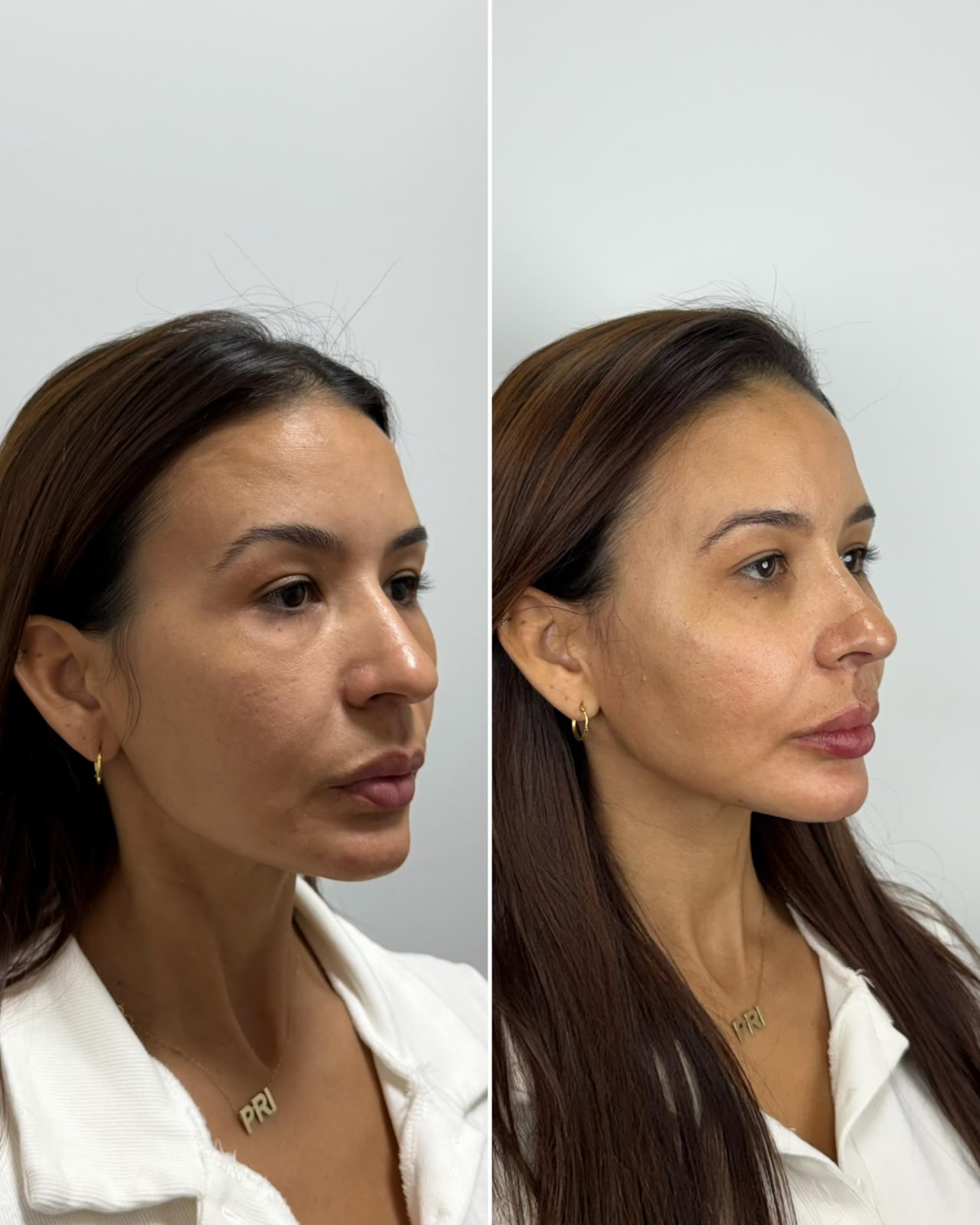 Antes e depois de harmonização orofacial: caso 4 — depois