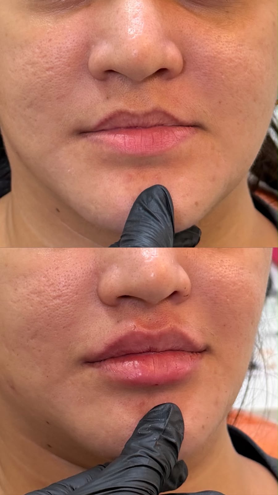 Antes e depois de harmonização orofacial: caso 2 — depois