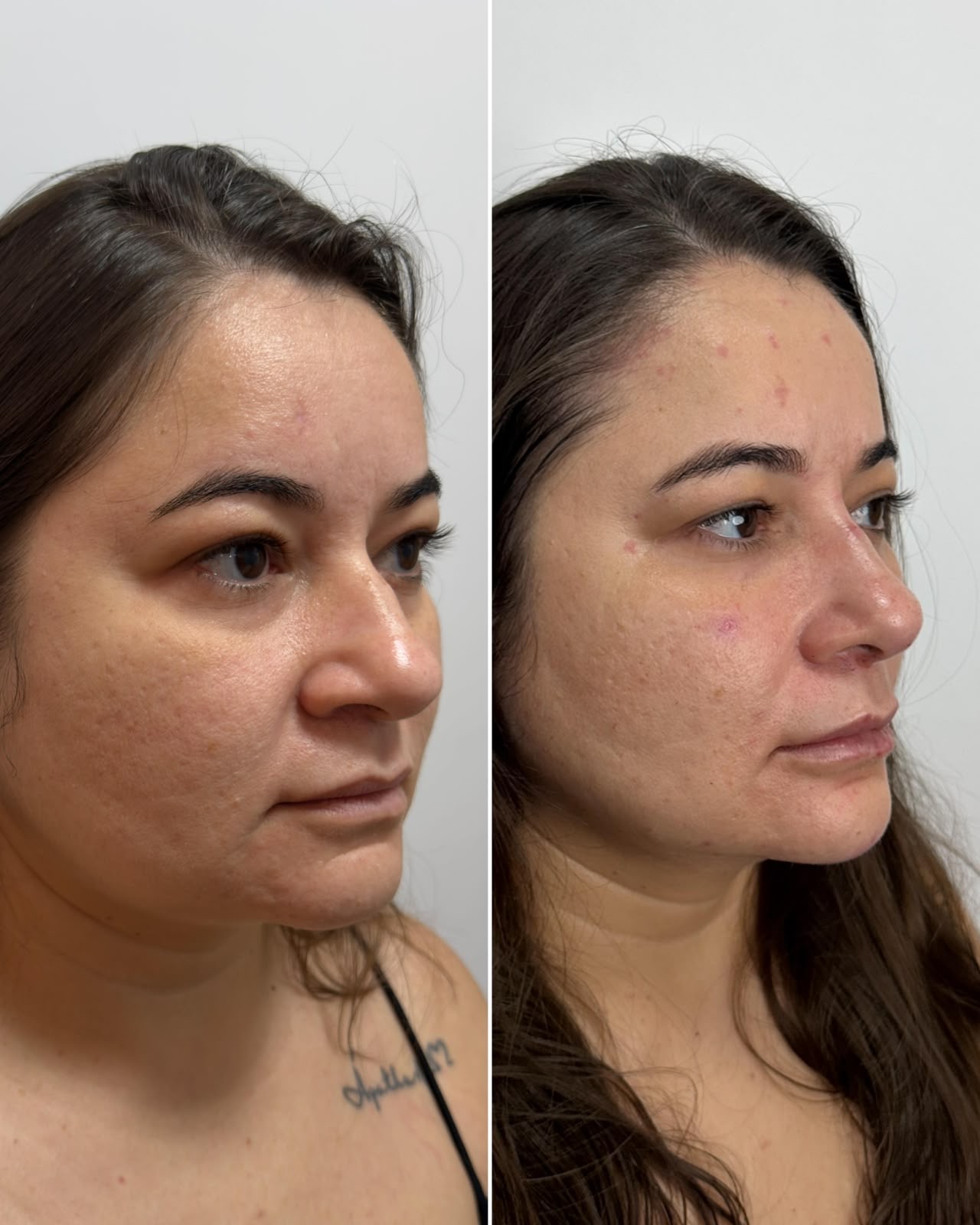 Antes e depois de harmonização orofacial: caso 3 — depois