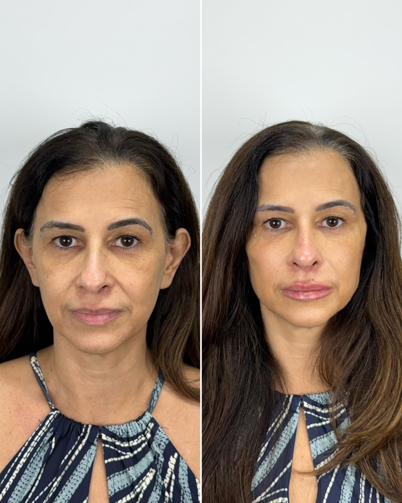 Antes e depois de harmonização orofacial: caso 5 — antes