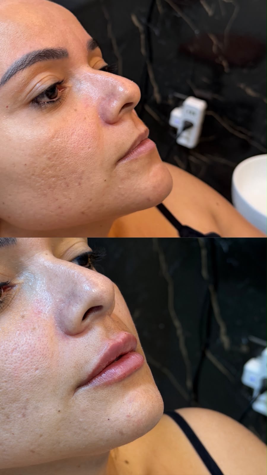Antes e depois de harmonização orofacial: caso 5 — depois