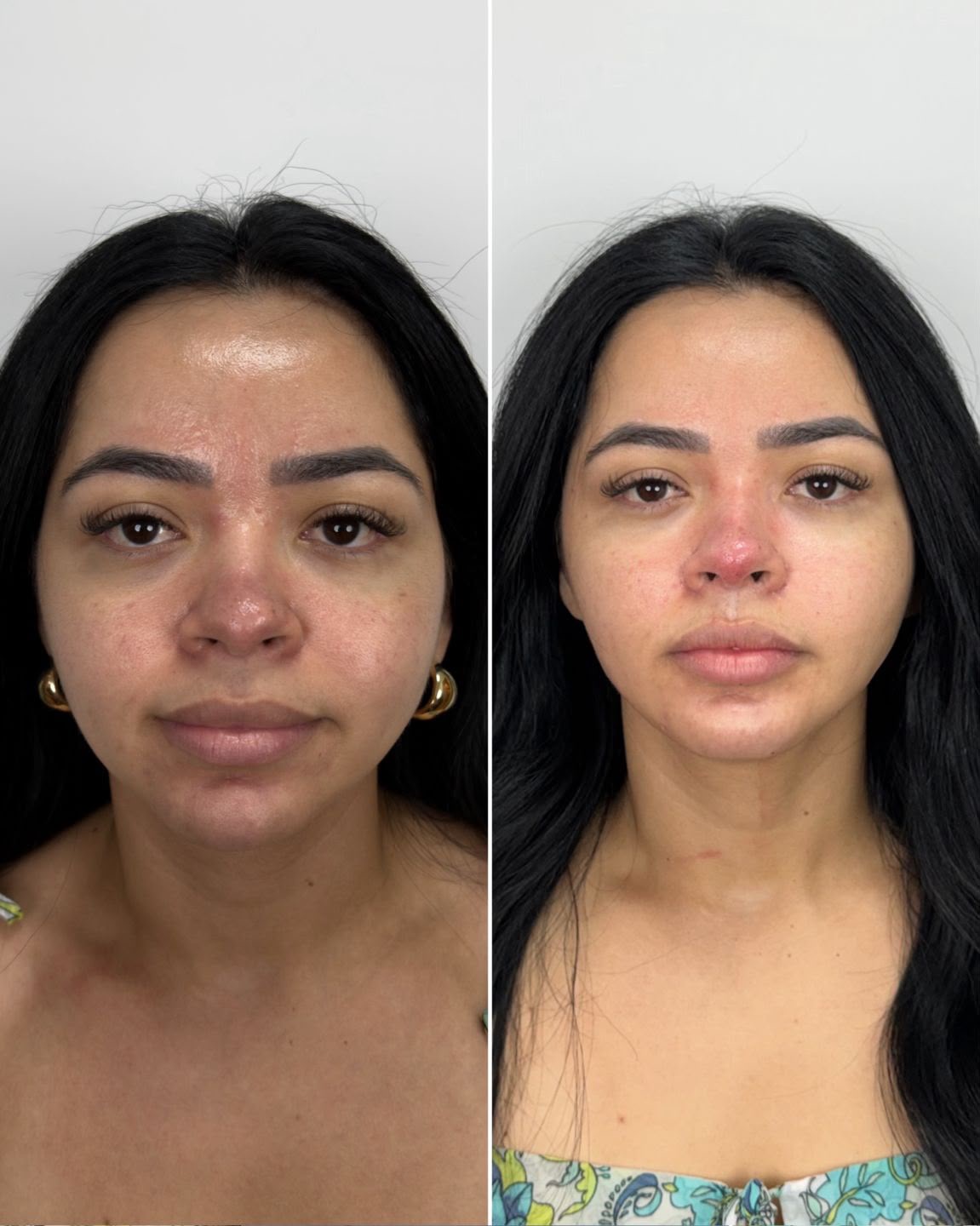 Antes e depois de harmonização orofacial: caso 3 — antes