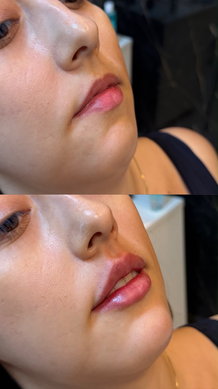 Antes e depois de harmonização orofacial: caso 2 — antes