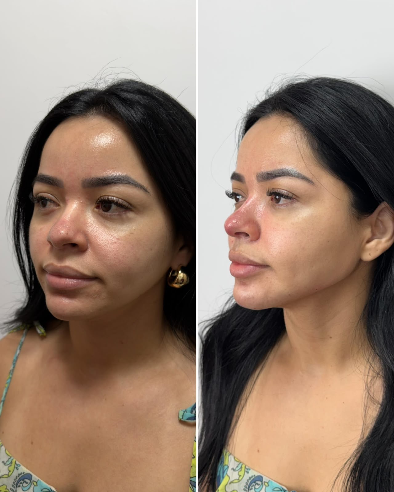 Antes e depois de harmonização orofacial: caso 4 — antes