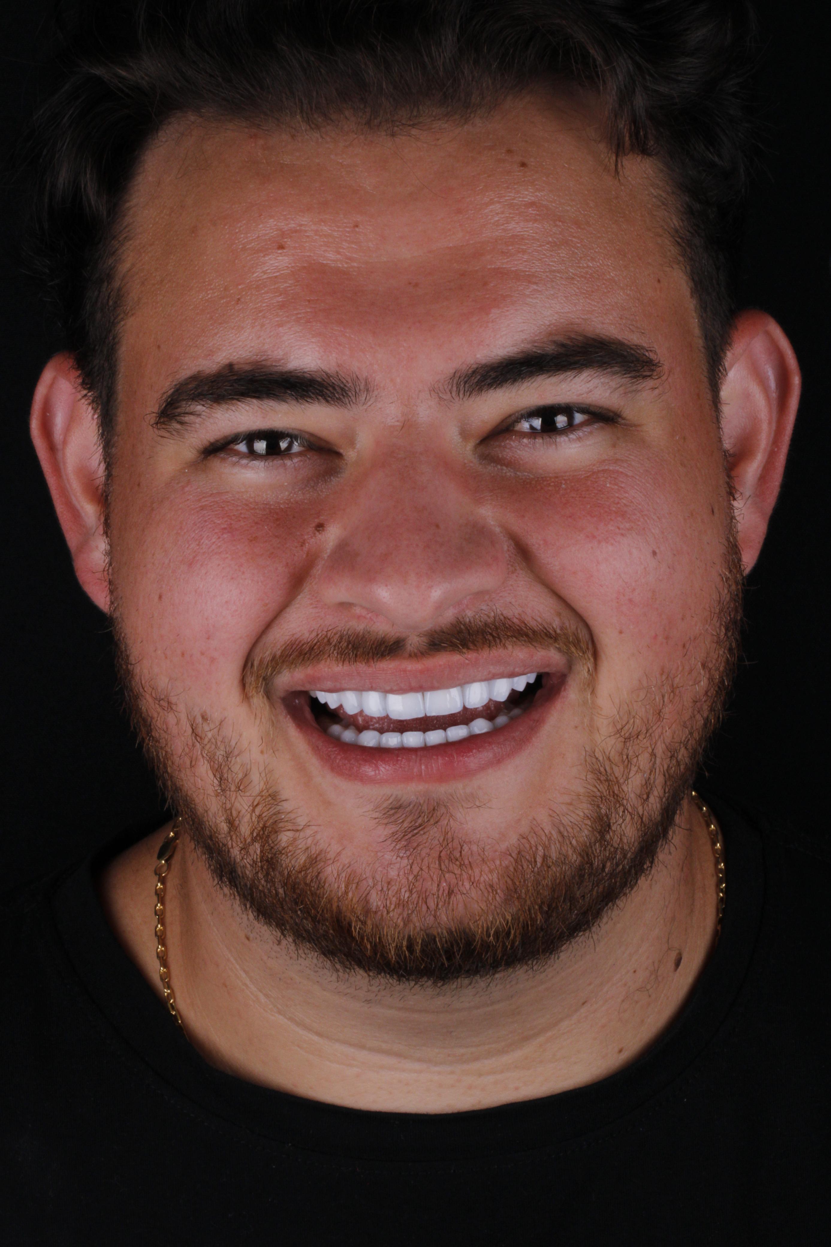 Antes e depois de estética dental: sorriso do caso 1 — antes